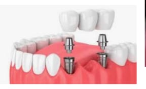 Implantes dentales en Astrabudua